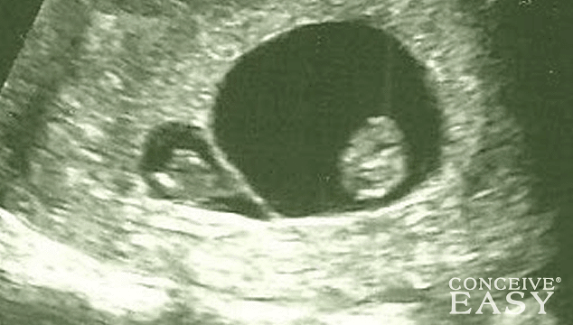 What is Vanishing Twin Syndrome (VTS)?