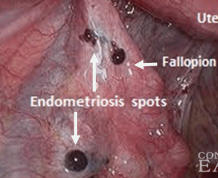 How Can I Get Pregnant with Endometriosis?
