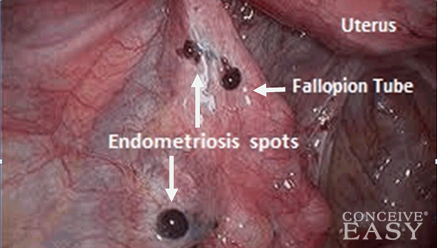 How Can I Get Pregnant with Endometriosis?