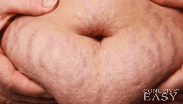 What Fertility Treatment is There for no Ovulation?