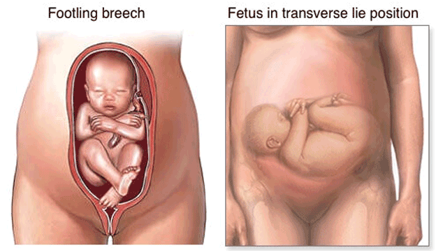 types of breech pregnancy