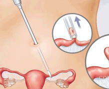 How Do I Get Pregnant if My Tubes are Burned?