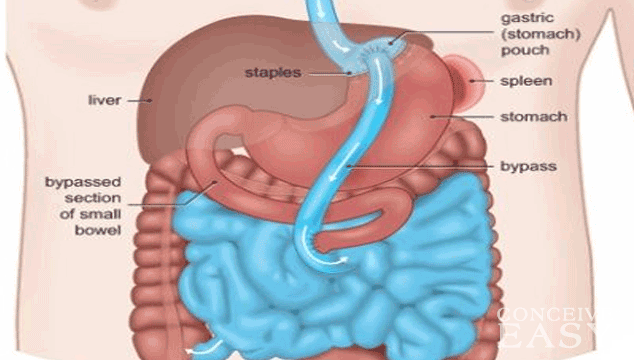 Trouble Getting Pregnant after Gastric Bypass