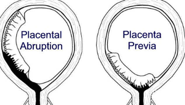 Trouble Getting Pregnant after Placental Abruption