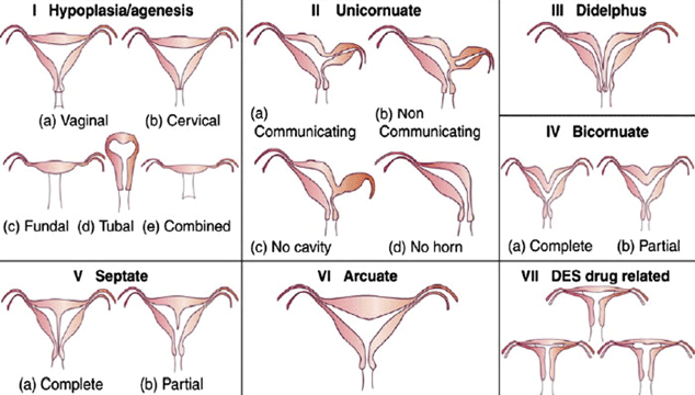 types of bicornuate uterus