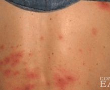 Do Shingles Cause Infertility?