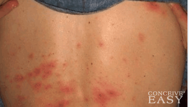 Do Shingles Cause Infertility?