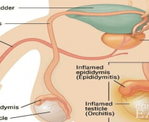 Does epididymitis cause infertility?