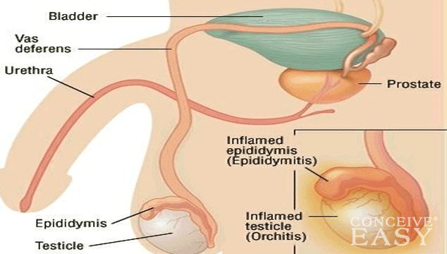 Does epididymitis cause infertility?