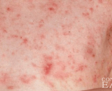 Does Scabies Cause Infertility?