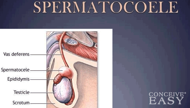 Does Spermatocele Cause Infertility?