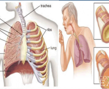 Home Remedies for Bronchitis