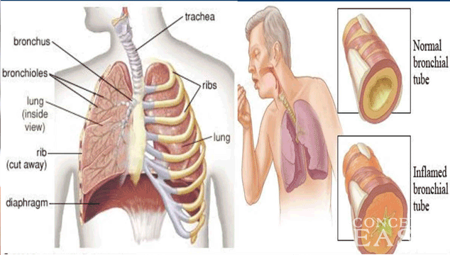 Home Remedies for Bronchitis