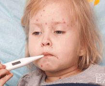 Home Remedies for Measles