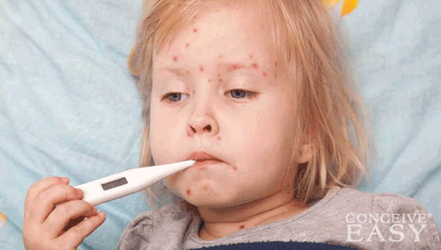 Home Remedies for Measles