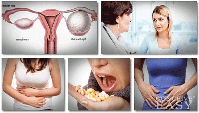 Home Remedies for Ovarian Cysts