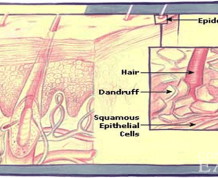 How to Treat Children's Dry Scalp