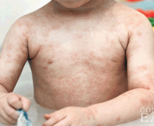 How to Treat Children's Skin Rashes