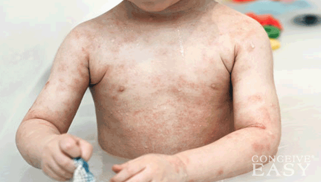 How to Treat Children's Skin Rashes