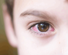 Home Remedies for Pink Eye for Infants