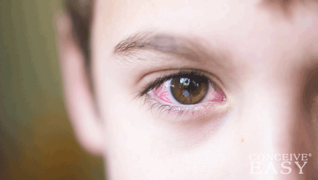 Home Remedies for Pink Eye for Infants