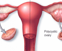 How to Get Pregnant with PCOS and no Period