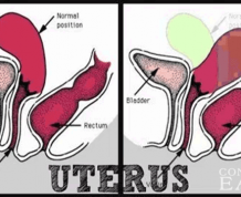 How to Get Pregnant with Retroverted Uterus and PCOS