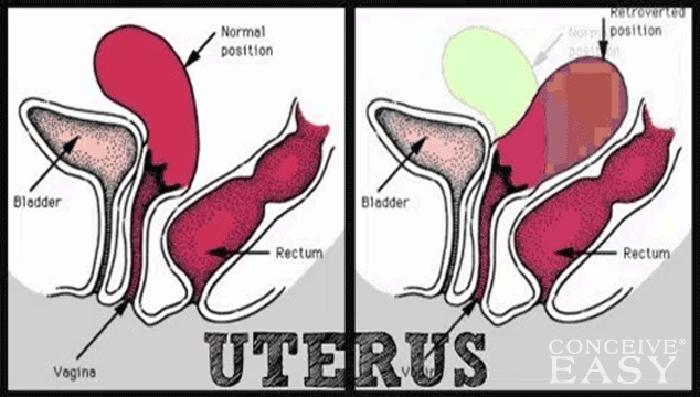 How to Get Pregnant with Retroverted Uterus and PCOS