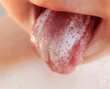 How to Treat Thrush in Children's Mouth