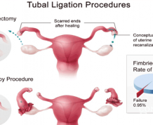 Home Remedy on Becoming Pregnant after Tubal Ligation