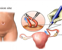 How Can I Get Pregnant with my Tubes Tied Without Surgery?