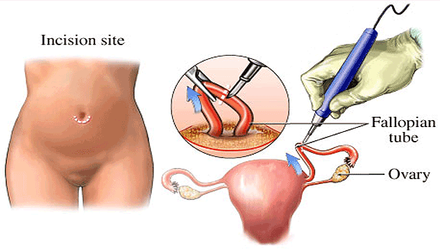 How Can I Get Pregnant with my Tubes Tied Without Surgery?