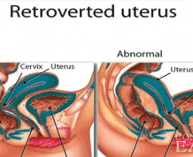 How to Get Pregnant with PCOS and Retroverted Uterus