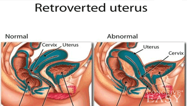 How to Get Pregnant with PCOS and Retroverted Uterus