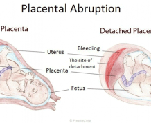 Abruptio Placenta in Early Pregnancy