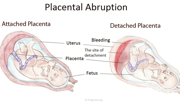 Abruptio Placenta in Early Pregnancy