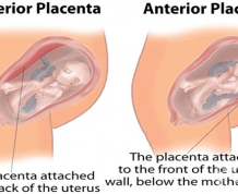 Amniocentesis with Anterior Placenta