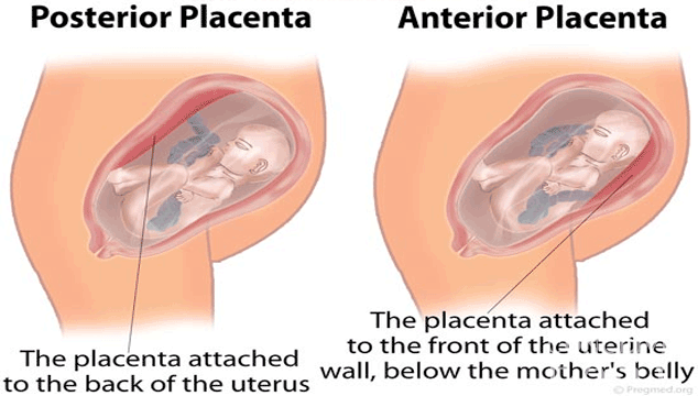 Amniocentesis with Anterior Placenta