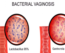 Bacterial Vaginosis Complications During Pregnancy