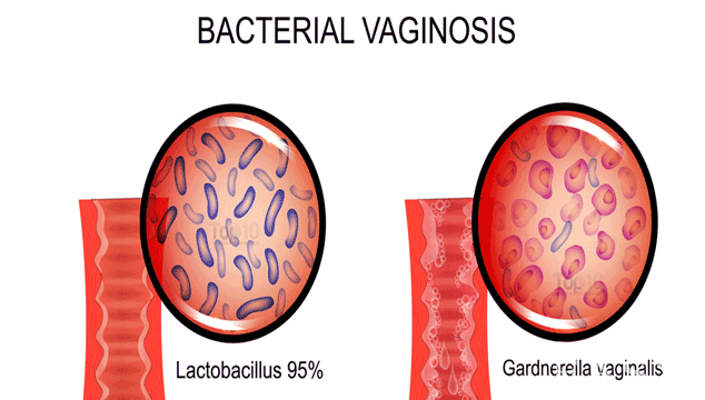 Bacterial Vaginosis Complications During Pregnancy