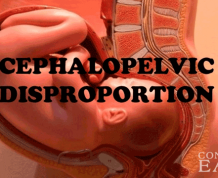 Cephalopelvic Disproportion vs Fetopelvic Disproportion