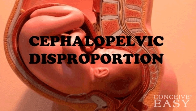 Cephalopelvic Disproportion vs Fetopelvic Disproportion