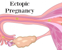 Ectopic Pregnancy Early Signs and Symptoms