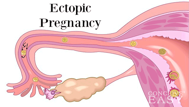 Ectopic Pregnancy Early Signs and Symptoms