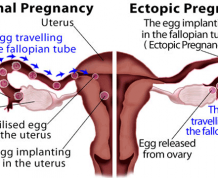 Ectopic Pregnancy vs Normal Pregnancy