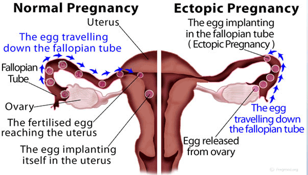 Ectopic Pregnancy vs Normal Pregnancy