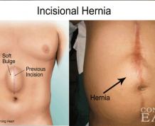 Hernia After Abdominal Surgery