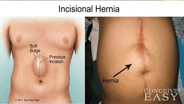 Hernia After Abdominal Surgery