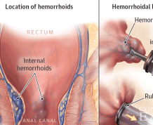 How Common are Hemorrhoids While Pregnant?