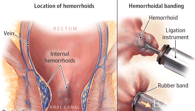 How Common are Hemorrhoids While Pregnant?